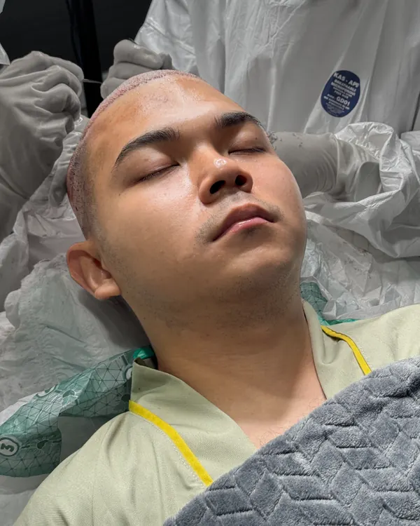 Hamizan beristirahat saat prosedur tanam rambut berlangsung